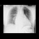 Lung fibrosis: X-ray - Plain radiograph