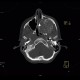 Fibrous dysplasia of the left maxillary sinus: CT - Computed tomography