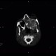 Fibrous dysplasia of the left maxillary sinus: CT - Computed tomography