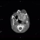 Fibrous dysplasia of the left maxillary sinus: CT - Computed tomography
