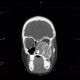 Fibrous dysplasia of the left maxillary sinus: CT - Computed tomography