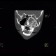 Fibrous dysplasia of the left maxillary sinus: CT - Computed tomography