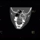 Fibrous dysplasia of the left maxillary sinus: CT - Computed tomography