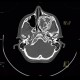Fibrous dysplasia of the left maxillary sinus: CT - Computed tomography