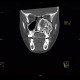 Fibrous dysplasia of the left maxillary sinus: CT - Computed tomography
