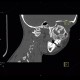 Fibrous dysplasia of the left maxillary sinus: CT - Computed tomography