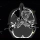 Fibrous dysplasia of the left maxillary sinus: CT - Computed tomography