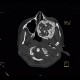 Fibrous dysplasia of the left maxillary sinus: CT - Computed tomography