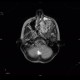 Fibrous dysplasia of the left maxillary sinus: MRI - Magnetic Resonance Imaging