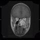 Fibrous dysplasia of the left maxillary sinus: MRI - Magnetic Resonance Imaging