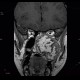 Fibrous dysplasia of the left maxillary sinus: MRI - Magnetic Resonance Imaging