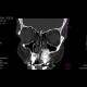 Fibrous dysplasia of maxilla: CT - Computed tomography