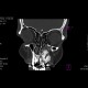 Fibrous dysplasia of maxilla: CT - Computed tomography