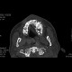 Fibrous dysplasia of maxilla: CT - Computed tomography