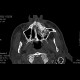 Fibrous dysplasia of maxilla: CT - Computed tomography