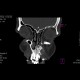 Fibrous dysplasia of maxilla: CT - Computed tomography