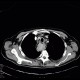 Fibrovascular polyp of oesophagus: CT - Computed tomography