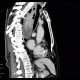 Fibrovascular polyp of oesophagus: CT - Computed tomography