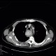 Fibrovascular polyp of oesophagus: CT - Computed tomography