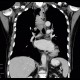 Fibrovascular polyp of oesophagus: CT - Computed tomography