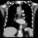 Fibrovascular polyp of oesophagus: CT - Computed tomography