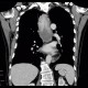 Fibrovascular polyp of oesophagus: CT - Computed tomography