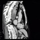 Fibrovascular polyp of oesophagus: CT - Computed tomography