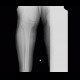 Periostosis, fibula, CVI, chronic venous insufficiency, perimalleolar edema: X-ray - Plain radiograph