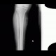 Periostosis, fibula, CVI, chronic venous insufficiency, perimalleolar edema: X-ray - Plain radiograph