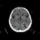 Fissure of skull, pneumocephalus, contusion: CT - Computed tomography