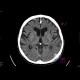 Fissure of skull, pneumocephalus, contusion: CT - Computed tomography