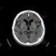Fissure of skull, pneumocephalus, contusion: CT - Computed tomography