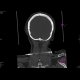 Fissure of the skull, pneumocephalus: CT - Computed tomography