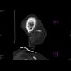 Fissure of the skull, pneumocephalus: CT - Computed tomography