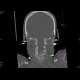 Fissure of the skull, pneumocephalus: CT - Computed tomography