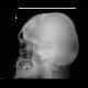 Fissure of skull, epidural hematoma: X-ray - Plain radiograph