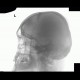 Fissure of skull, epidural hematoma: X-ray - Plain radiograph