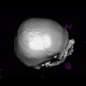 Fissure of skull, epidural hematoma: CT - Computed tomography