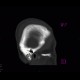 Fissure of skull, epidural hematoma: CT - Computed tomography