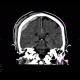 Fissure of skull, epidural hematoma: CT - Computed tomography