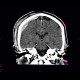 Fissure of skull, epidural hematoma: CT - Computed tomography