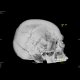 Fissure of the skull and epidural hematoma: CT - Computed tomography