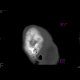 Fissure of the skull: CT - Computed tomography