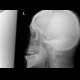 Fissure of the skull, mandible: X-ray - Plain radiograph