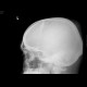 Skull fissure: X-ray - Plain radiograph