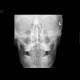 Skull fissure: X-ray - Plain radiograph
