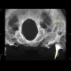 Fissure of occipital bone, terminating in foramen magnum: CT - Computed tomography