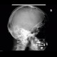 Skull fissure, temporal bone, occipital bone: X-ray - Plain radiograph