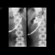 Fistulography of a cavity adjacent to pancreas: RF - Fluoroscopy