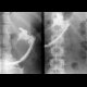 Fistulography of a cavity adjacent to pancreas: RF - Fluoroscopy